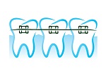 Braces in Scarborough Toronto