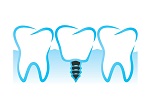 Implant in Scarborough Toronto