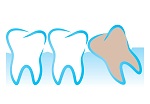 Wisdom Teeth in Scarborough Toronto